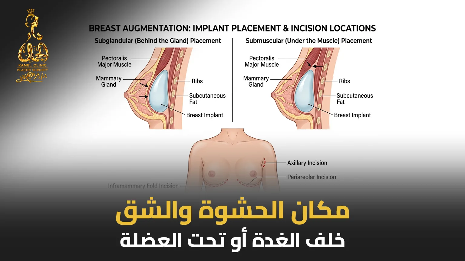 العوامل المؤثرة في تكلفة عملية تكبير الثدي في مصر
