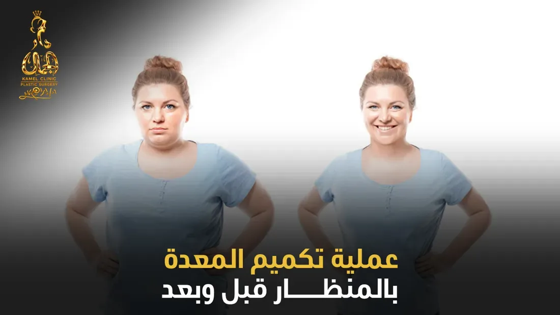 نتائج عملية تكميم المعدة بالمنظار قبل وبعد في مركز دار الجمال