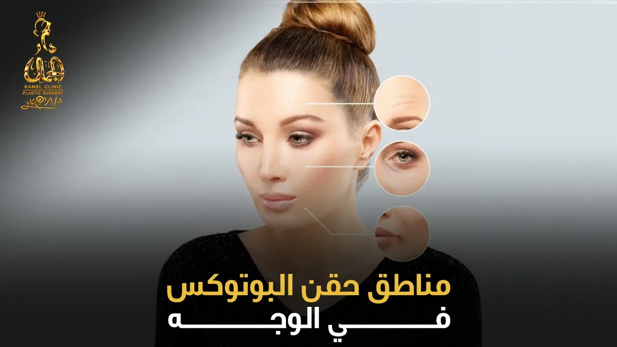 مناطق حقن البوتوكس في الوجه - انفوغرافيك
