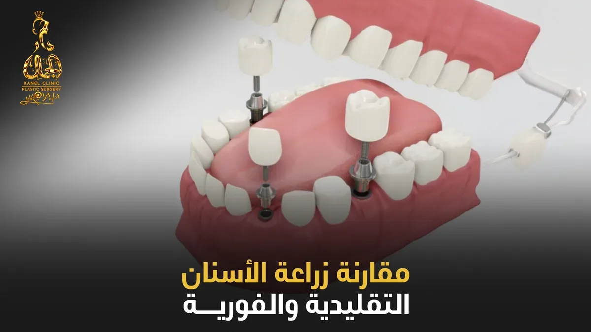مقارنة زراعة الأسنان التقليدية والفورية