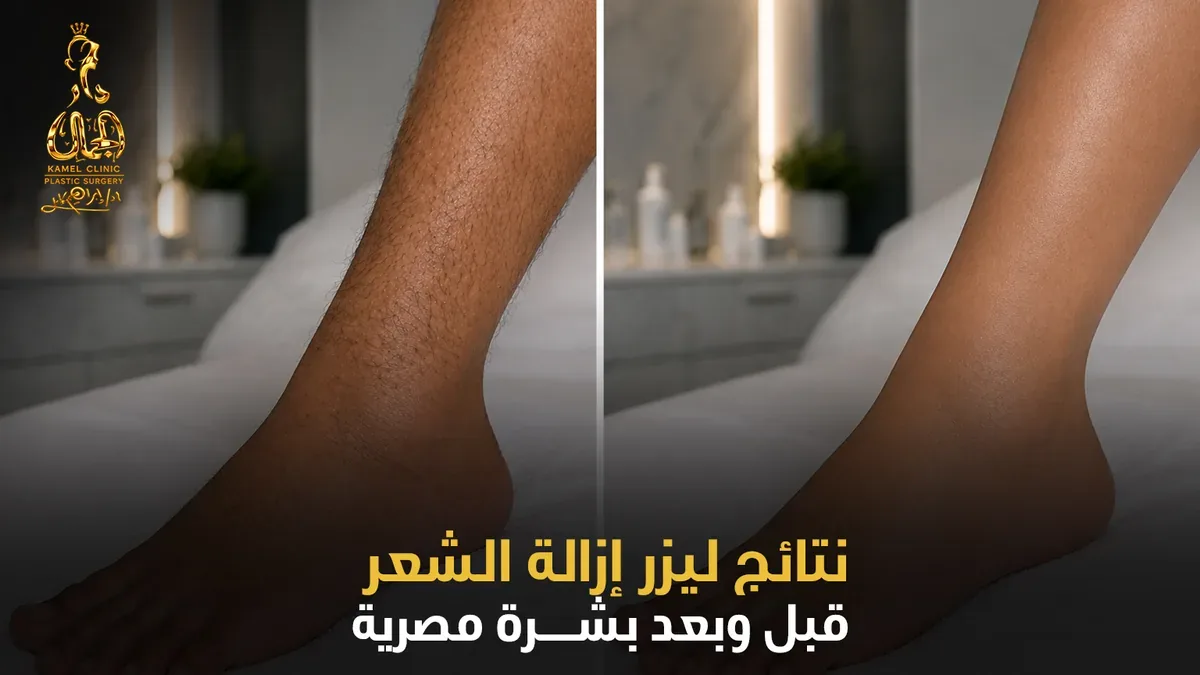 نتائج ليزر إزالة الشعر قبل وبعد بشرة مصرية