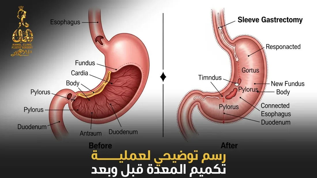 رسم توضيحي لعملية تكميم المعدة قبل وبعد في مركز دار الجمال