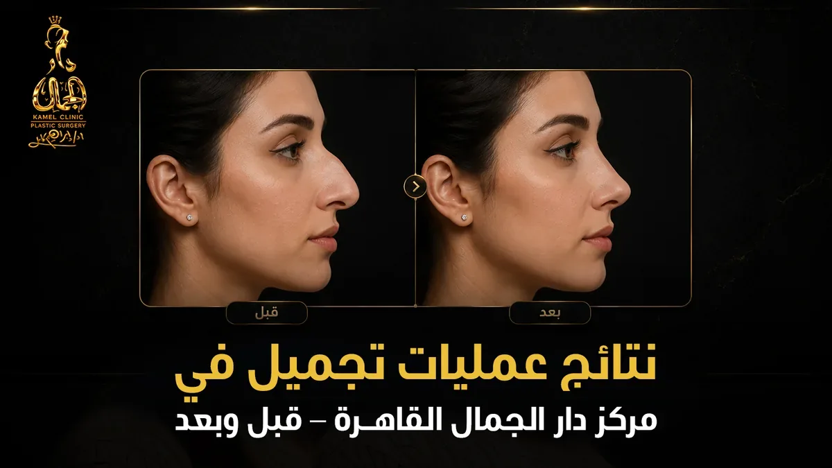 نتائج عمليات تجميل في مركز دار الجمال القاهرة - قبل وبعد