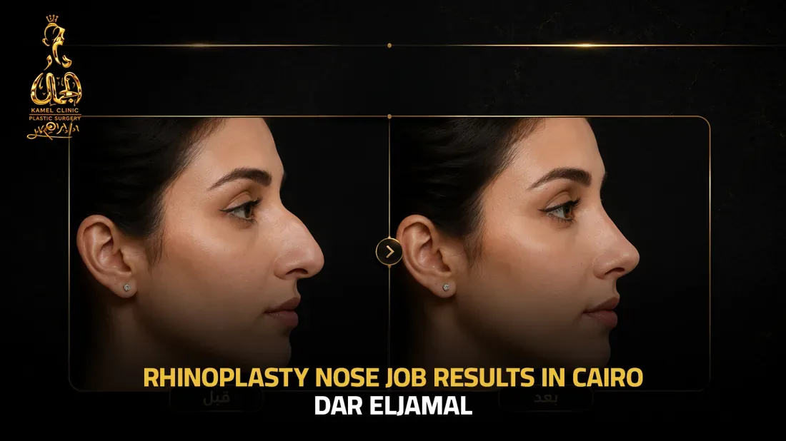 Rhinoplasty nose job before and after results in Cairo at Dar El Gamal
