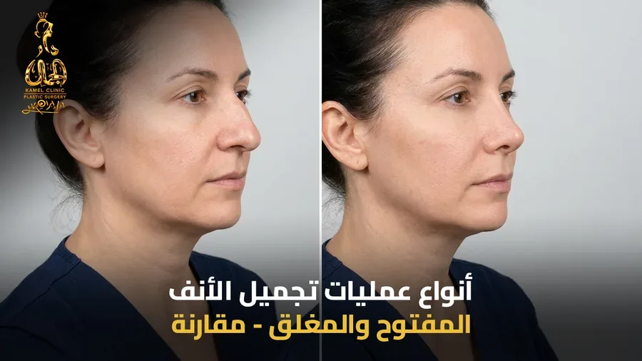 أنواع عمليات تجميل الأنف المفتوح والمغلق في مركز دار الجمال
