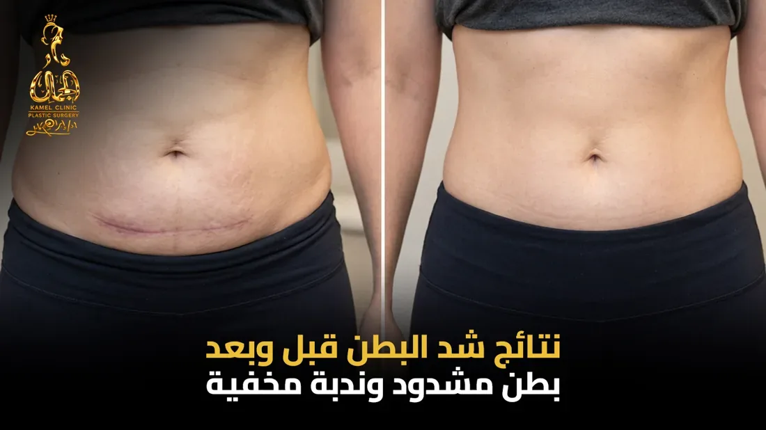 العوامل المؤثرة في تكلفة عملية شد البطن بعد الولادة القيصرية في مصر