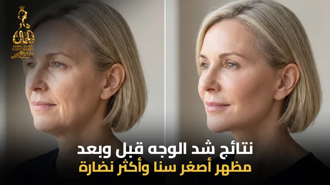 نتائج عملية شد الوجه ومدة استمرارها في مركز دار الجمال